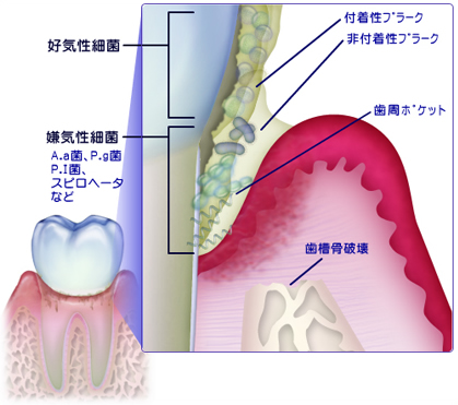 歯周病