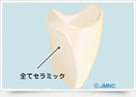 オールセラミック