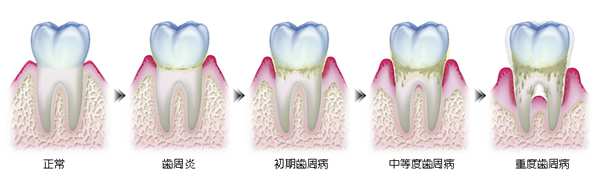 歯周病の進行